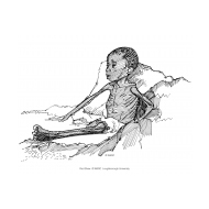 Child with marasmus (Artist: Shaw, Rod)
